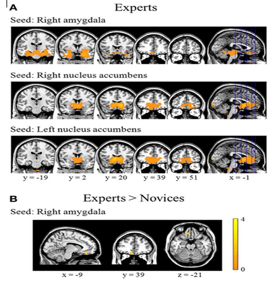 ▲ A. 바둑전문가들에서 우측 편도체(Amygdala), 측좌핵(Nucleus accumbens)과 안와전두엽 사이에서 유의한 기능적 연결성의 증가가 관찰되었음. B. 바둑전문가들은 일반 성인에 비하여 우측편도체와 안와전두엽 사이의 기능적 연결성의 증가가 현저히 증가되었음. 